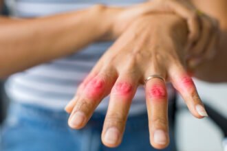 ревматоїдний артрит